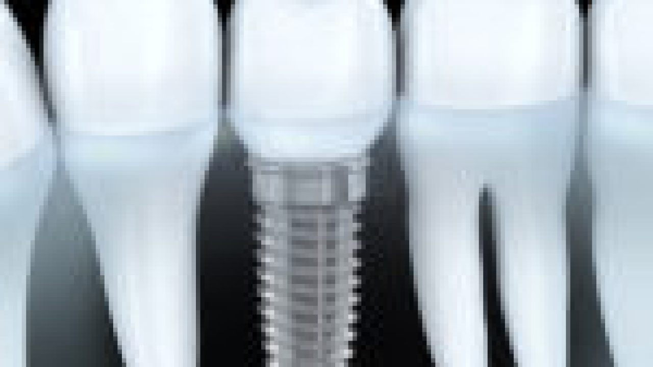 Tooth human implant (done in 3d graphics)